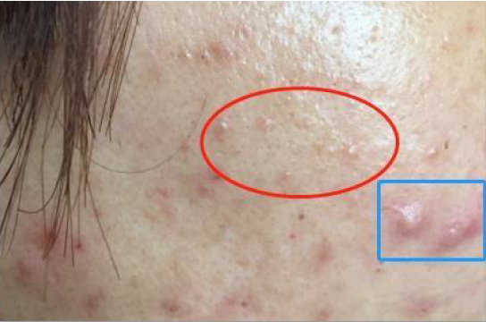 Spot Gel — fast-acting anti-acne in-vivo study panel - Before