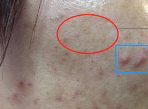 Spot Gel — fast-acting anti-acne in-vivo study panel - After 4 hours