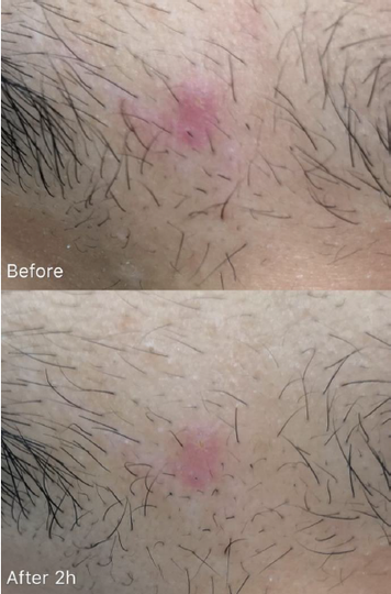 Spot Gel — fast-acting anti-acne in-vivo study panel - Body application, before and after 2 hours