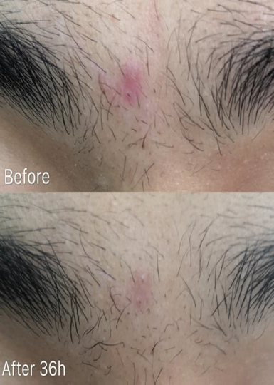 Spot Gel — fast-acting anti-acne in-vivo study panel - Body application, before and after 36 hours