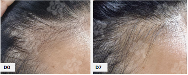 Hair Growth Scalp Serum in-vivo study panel - Hairline, day 0 and day 7