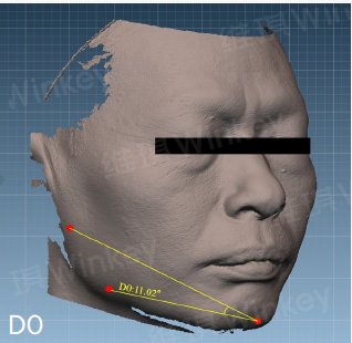 Hair Growth Scalp Serum in-vivo study panel - Jawline lifting and tightening, day 0