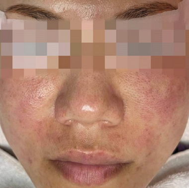 Soothing Serum for compromised skin in-vivo study panel - Before