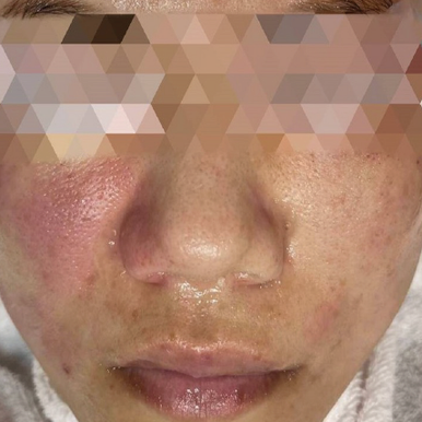 Soothing Serum for compromised skin in-vivo study panel - 15 minutes after treatment