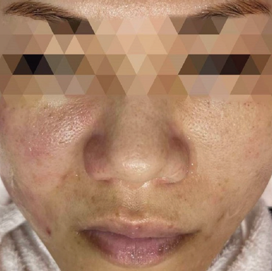 Soothing Serum for compromised skin in-vivo study panel - 30 minutes after treatment