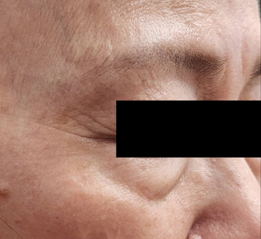 Instant Anti-Wrinkle Serum in-vivo study panel - Before