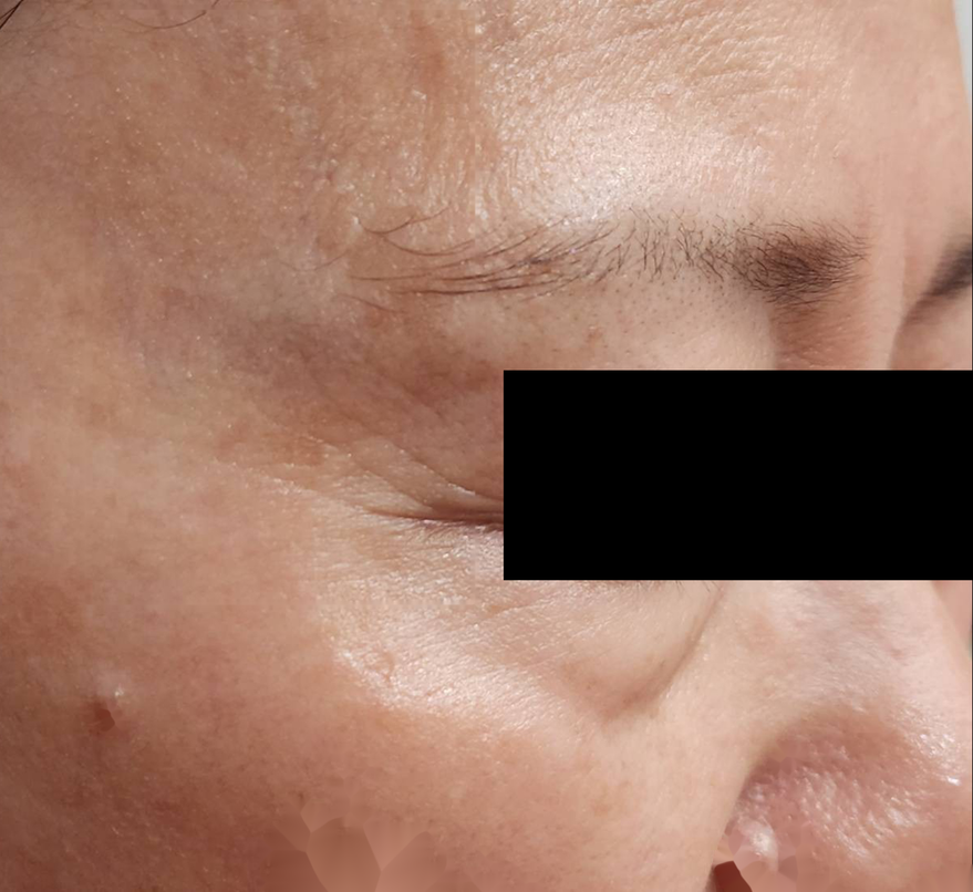 Instant Anti-Wrinkle Serum in-vivo study panel - After 3 minutes