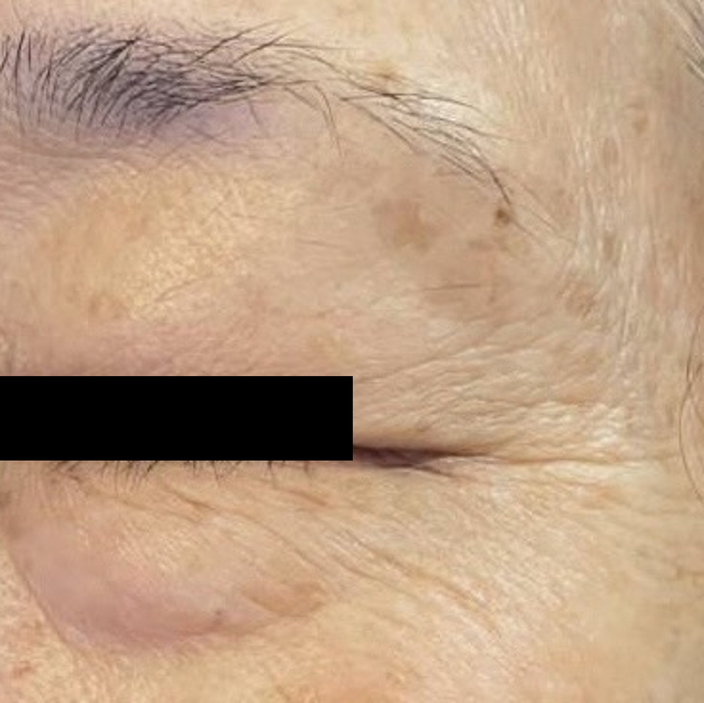 Instant Anti-Wrinkle Serum in-vivo study panel - Eye area, before