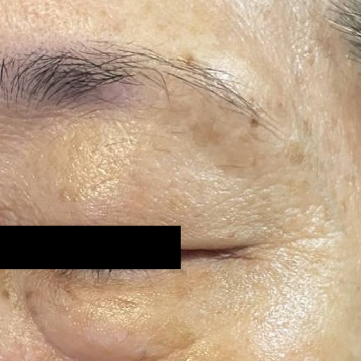 Instant Anti-Wrinkle Serum in-vivo study panel - Eye area, after 3 minutes